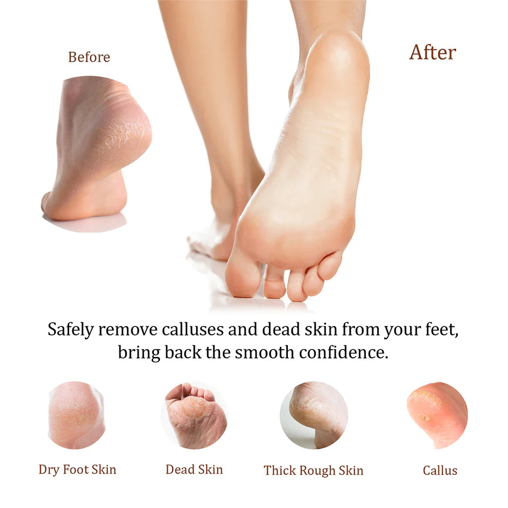 KDS Natural Feet Callus Remover 1Gal